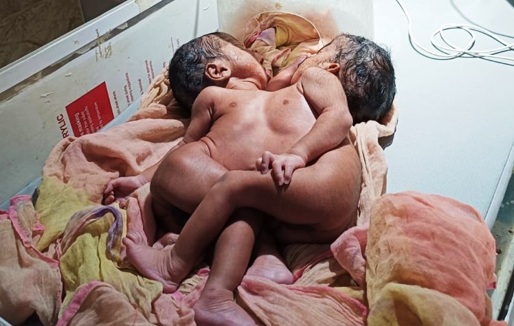छाती जुड़े अनोखे जुड़वां बच्चों का हुआ जन्म